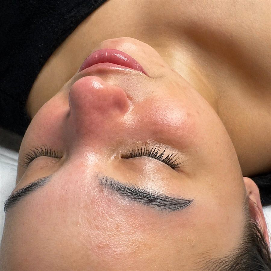 Cejas despu&eacute;s caso 1